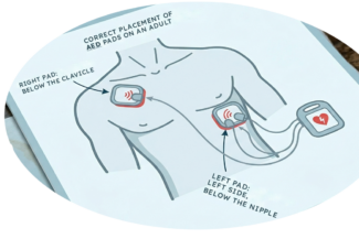 AED Pads placement